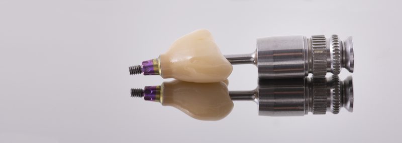 PFM implant crown — porcelain fused to metal on implant